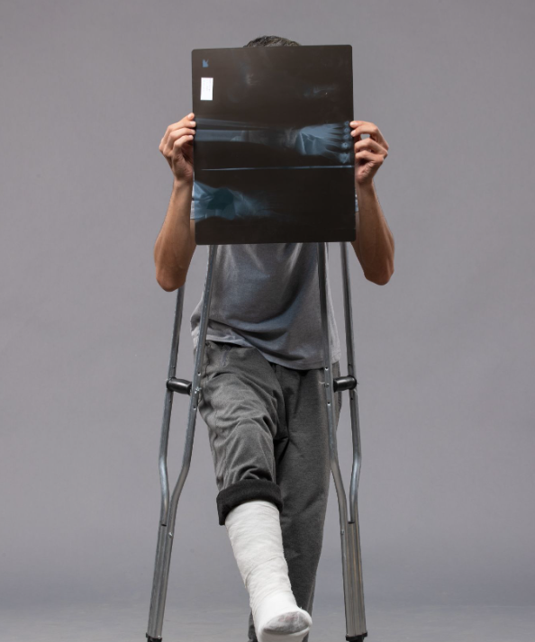 Paciente com fratura na perna utilizando muletas e segurando uma radiografia, ilustrando o tratamento do trauma ortopédico e a necessidade de sistemas de fixação óssea.